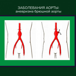 Заболевания аорты: аневризма брюшной аорты Заболевания аорты: аневризма брюшной аорты