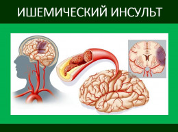 НАРУШЕНИЯ МОЗГОВОГО КРОВООБРАЩЕНИЯ: ишемический инсульт НАРУШЕНИЯ МОЗГОВОГО КРОВООБРАЩЕНИЯ: ишемический инсульт