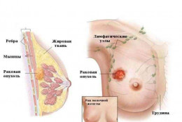 Рак молочный железы: распространённость и причины