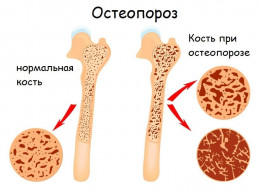 Что такое остеопороз?