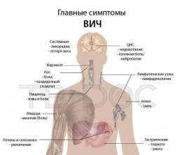 Какие признаки и симптомы могут говорить о ВИЧ-инфекции? Какие признаки и симптомы могут говорить о ВИЧ-инфекции?