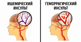 Что такое инсульт? Что такое инсульт?